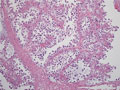 卵巣明細胞腺癌ミクロ像(HE中拡大）