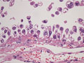 卵巣明細胞腺癌ミクロ像(HE強拡大）