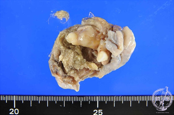 卵巣成熟嚢胞性奇形腫マクロ像