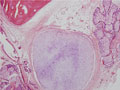 卵巣奇形腫（成熟嚢胞性奇形腫）ミクロ像（HE弱拡大）