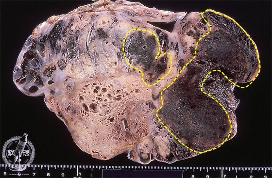 卵黄嚢腫瘍マクロ像