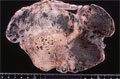 卵黄嚢腫瘍マクロ像