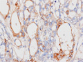 卵黄嚢腫瘍ミクロ像（α-フェトプロテイン（AFP）免疫染色強拡大） 