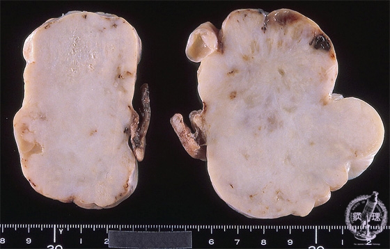 クルケンベルグ腫瘍マクロ像