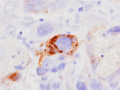 絨毛癌ミクロ像（ヒト絨毛性ゴナドトロピン（h-CG）免疫染色強拡大）