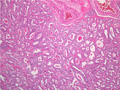 前立腺癌（腺癌、Ｇｌｅａｓｏｎ分類）ミクロ像（HE中拡大）