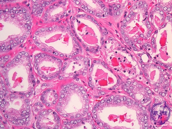前立腺癌（腺癌、Ｇｌｅａｓｏｎ分類）ミクロ像（HE強拡大）