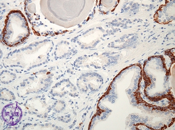 前立腺癌（腺癌、Ｇｌｅａｓｏｎ分類）ミクロ像（ keratin 903免疫染色強拡大）