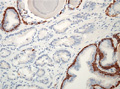 前立腺癌（腺癌、Ｇｌｅａｓｏｎ分類）ミクロ像（ keratin 903免疫染色強拡大） 