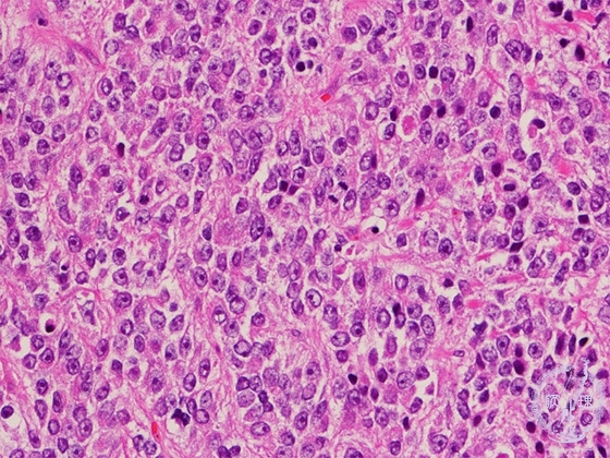 前立腺癌（腺癌、Ｇｌｅａｓｏｎ分類）ミクロ像（HE強拡大）