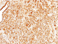 前立腺癌（腺癌、Ｇｌｅａｓｏｎ分類）ミクロ像（PSA免疫染色中拡大）