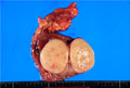 精上皮腫（胚細胞腫）マクロ像