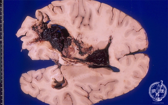 脳出血（脳内出血）マクロ像（左視床出血）
