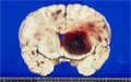 脳出血（脳内出血）マクロ像（右基底核出血）