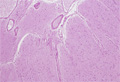 膠細胞腫（星細胞膠腫）ミクロ像（HE弱拡大）Fibrillary astrocytoma(線維性星細胞膠腫）