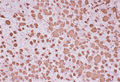 膠細胞腫（星細胞膠腫）ミクロ像（GFAP免疫染色） Gemistocytic astrocytoma(肥胖型星細胞膠腫） 