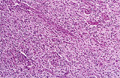 膠細胞腫（星細胞膠腫）ミクロ像（HE弱拡大）Anaplastic astrocytoma(退形成性星細胞膠腫）