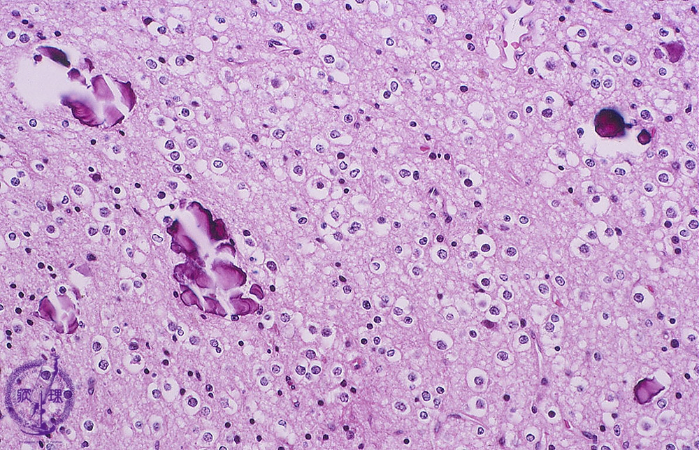 神経芽細胞腫