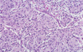 髄膜腫ミクロ像（HE強拡大）Meningothelial meningioma(髄膜皮性髄膜腫）