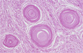 髄膜腫ミクロ像（HE中拡大）Psammomatous meningioma（砂粒腫性髄膜腫）