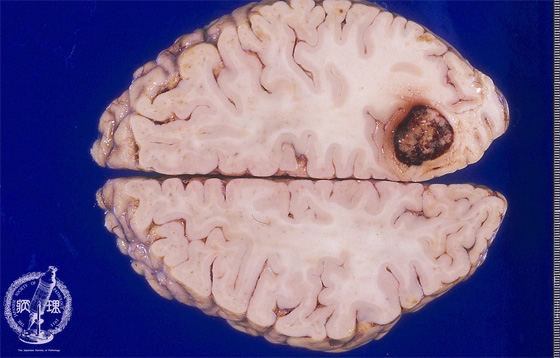 転移性脳腫瘍マクロ像（肺癌の脳転移）