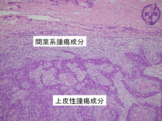 滑膜肉腫（二相性）ミクロ像（HE弱拡大）