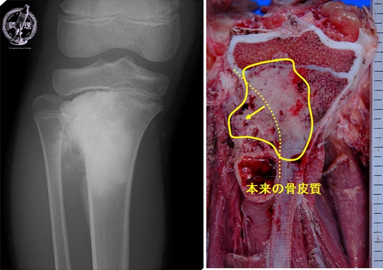 骨肉腫X線像（左）とマクロ像（右）