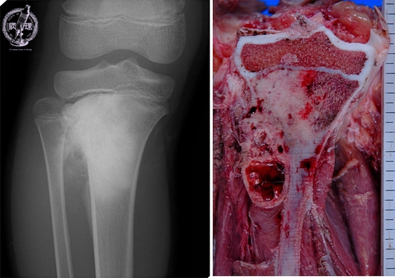 骨肉腫X線像（左）とマクロ像（右）