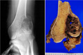 骨巨細胞腫X線像（左）とマクロ像（右）