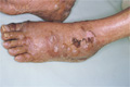 水疱性皮膚疾患（水疱性類天疱瘡）マクロ像