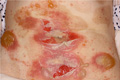 水疱性皮膚疾患（尋常性天疱瘡）マクロ像