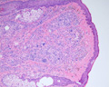 母斑細胞母斑（真皮内・境界・複合）ミクロ像（HE弱拡大）