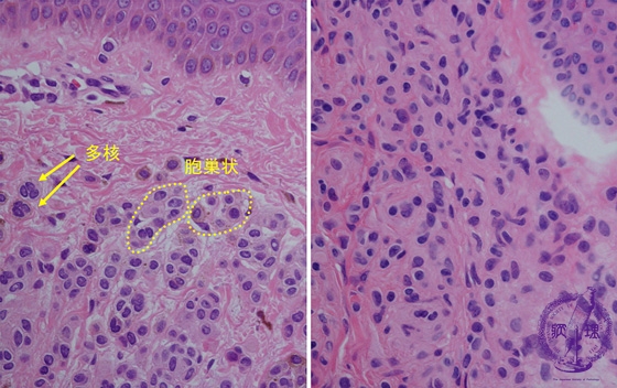 母斑細胞母斑（真皮内・境界・複合）ミクロ像（HE強拡大）