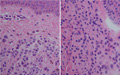 母斑細胞母斑（真皮内・境界・複合）ミクロ像（HE強拡大）