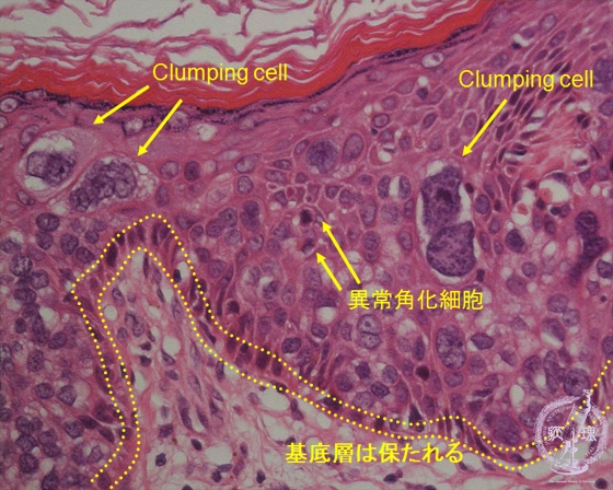 �G�������i�������Ƃ���Bowen�a�j�~�N�����iHE���g��j