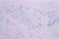 乳房外Paget病ミクロ像（アルシアン青（alcian blue）染色強拡大）