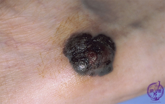 T細胞リンパ腫の診断