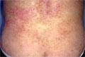 皮膚悪性リンパ腫（菌状息肉症）マクロ像