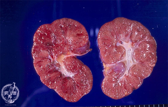 乳児型多嚢胞腎マクロ像
