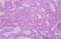 乳児型多嚢胞腎ミクロ像（HE強拡大）