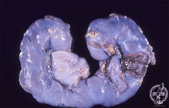 馬蹄腎マクロ像