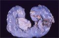 馬蹄腎マクロ像