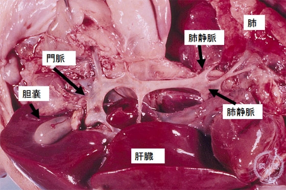 先天性心奇形（総肺静脈還流異常）マクロ像