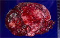 神経芽腫群腫瘍（低分化型神経芽細胞腫）マクロ像