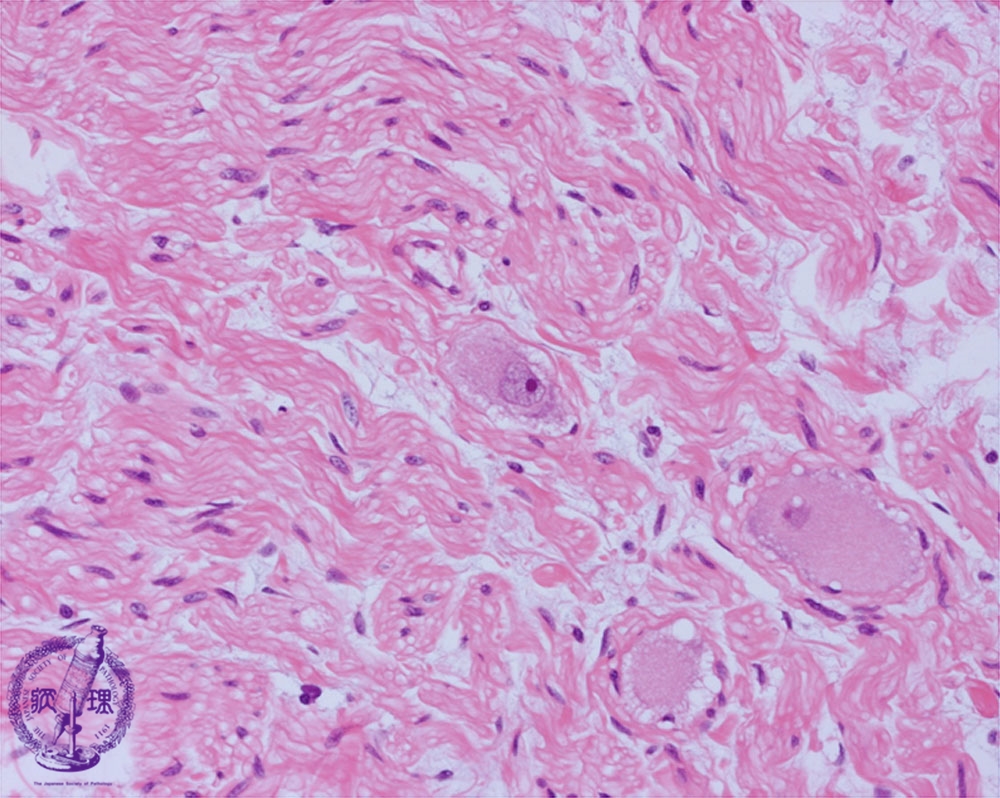 .小児病理 9神経芽腫群腫瘍神経節細胞腫 病理コア画像