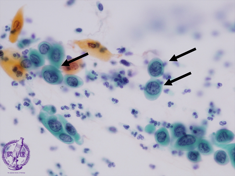 最も一般的な種類の非黒色腫皮膚がんは何ですか?
