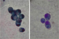 腹水細胞診（胃印環細胞癌）腹水沈渣塗沫像（左：パパニコロウ染色、右PAS染色強拡大）