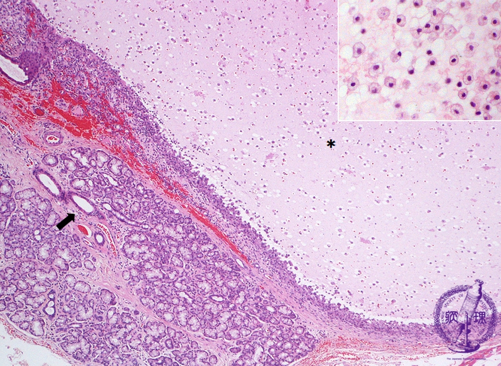 7oral Salivary Gland 2 Mucocelepathology Core Pictures
