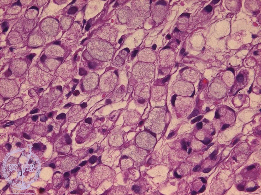 Pathology 521 d Linitis Plastica scirrhous carcinoma stomach leather bottle cancer  Signet ring - YouTube
