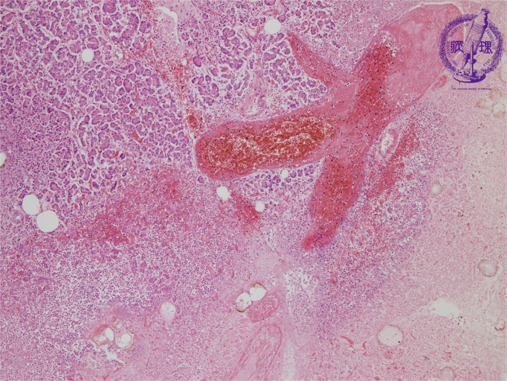 Hemorrhagic Pancreatitis Histology